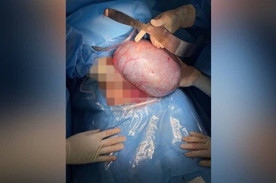 خارج کردن توده ۷ کیلویی از شکم بیمار آملی